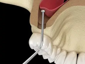 Intervention de sinus lift pour implantation dentaire au cabinet d’Esnandes, proche de La Rochelle