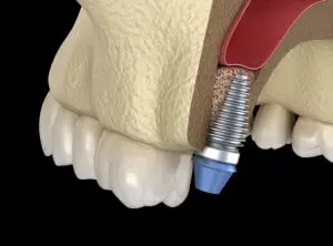 Pose de la vis implantaire après sinus lift au cabinet d’Esnandes, près de La Rochelle